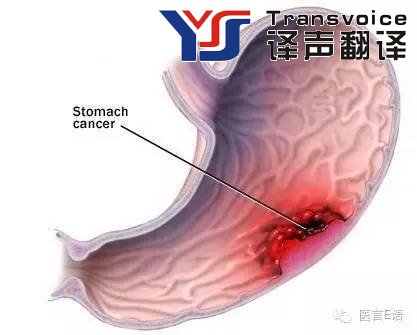 醫(yī)學(xué)翻譯：消化科——胃癌(圖1)